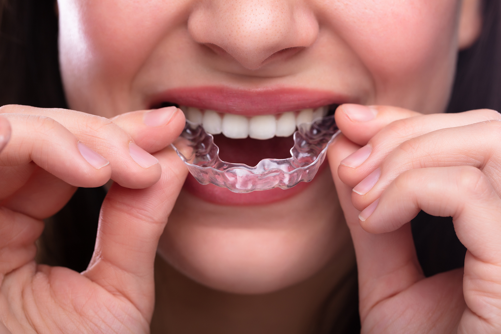 Straighten Your Smile with Clear Aligners in Zionsville, IN