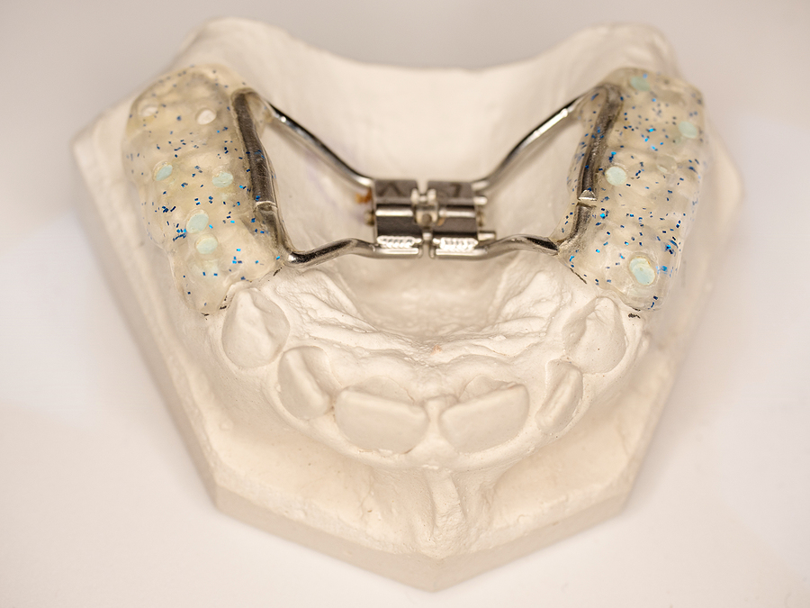 Expanders: A Key Orthodontic Solution for a Healthier Smile in Zionsville, IN & Lebanon, IN