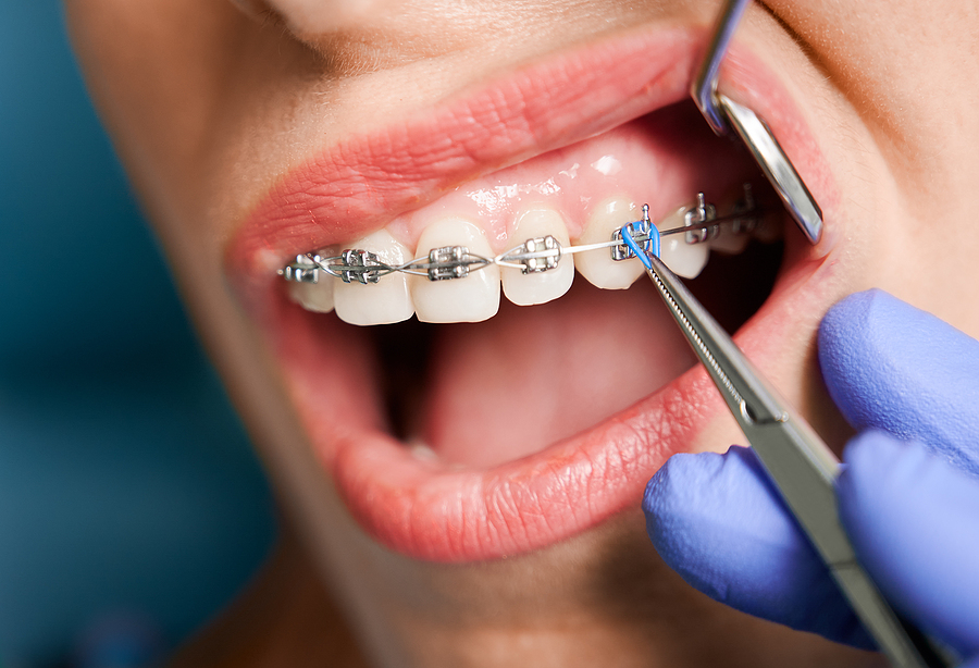 5 Common Questions About Orthodontic Treatments Answered