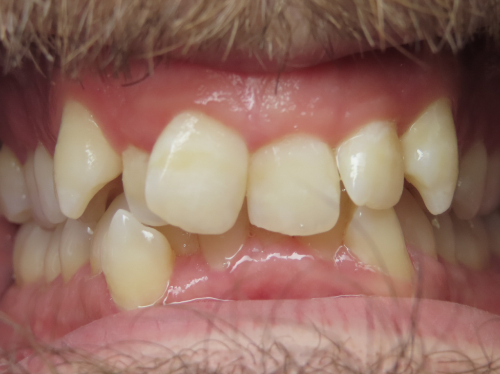 dentist zionsville in smile gallery 10 migrated