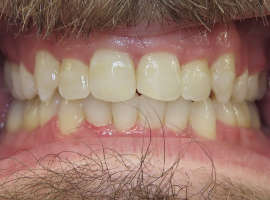 dentist zionsville in smile gallery 11 migrated