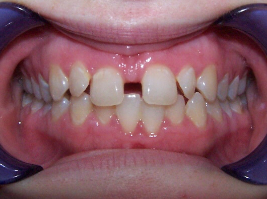 dentist zionsville in smile gallery 20 migrated