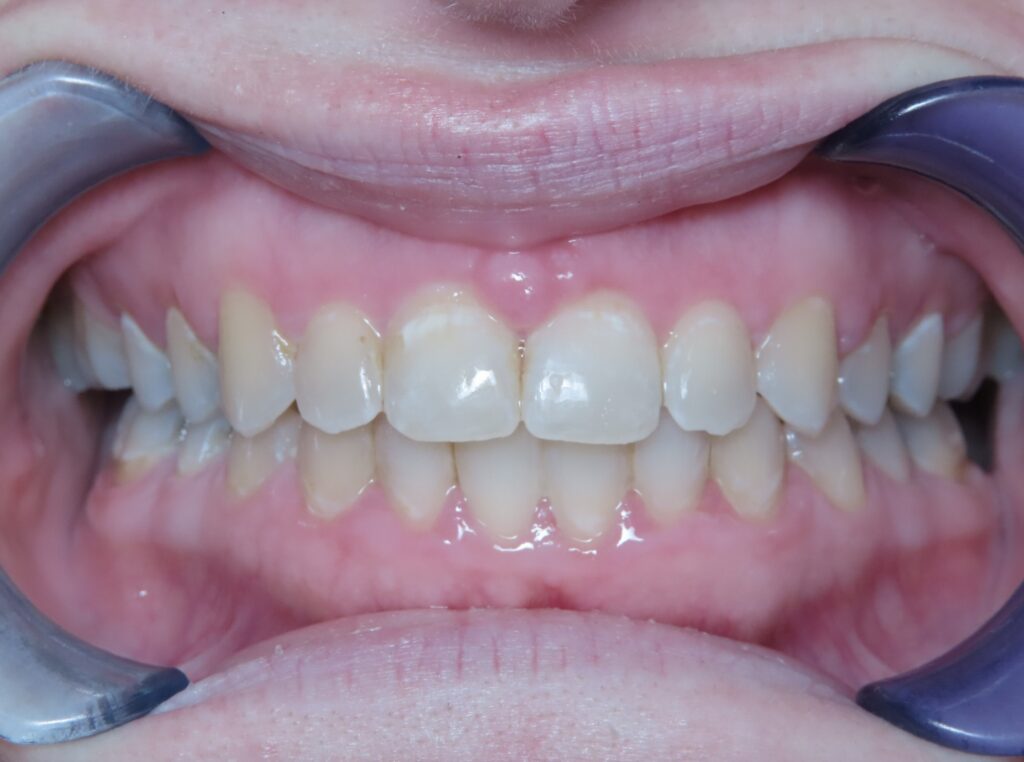 dentist zionsville in smile gallery 21 migrated