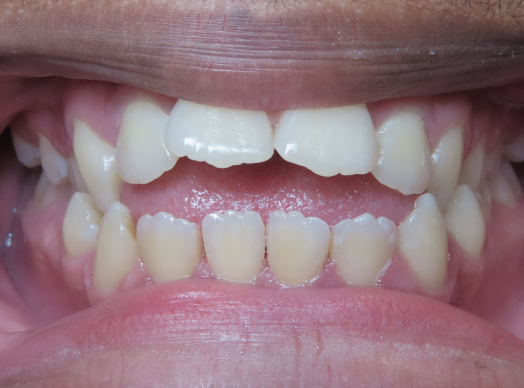 dentist zionsville in smile gallery 30 migrated