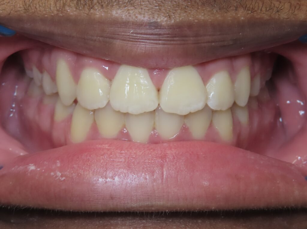 dentist zionsville in smile gallery 31 migrated scaled